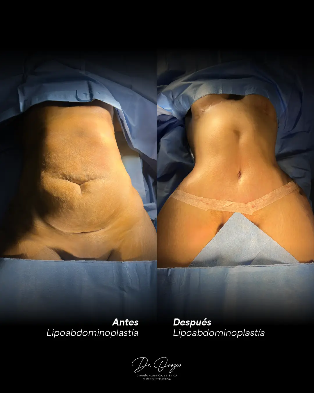 Abdomen avant et après une lipo-abdominoplastie