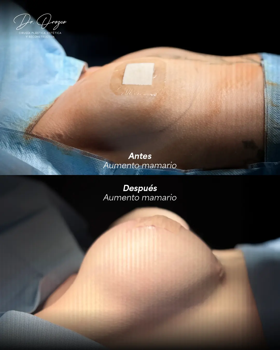 Breast before and after implant placement during an augmentation