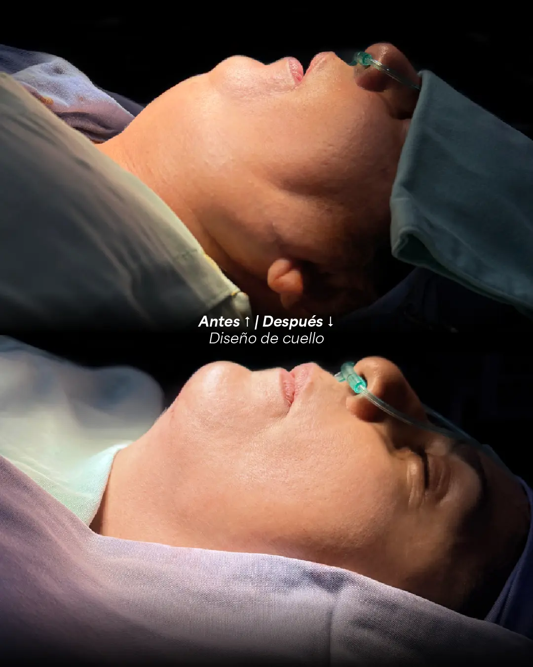 Neck and chin angle before and after a neck treatment