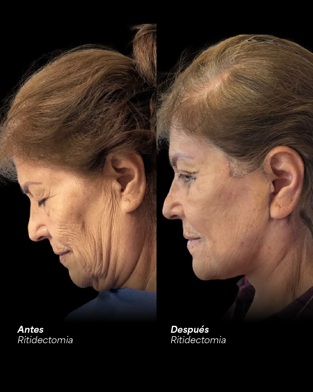 Face and neck in profile before and after a facelift