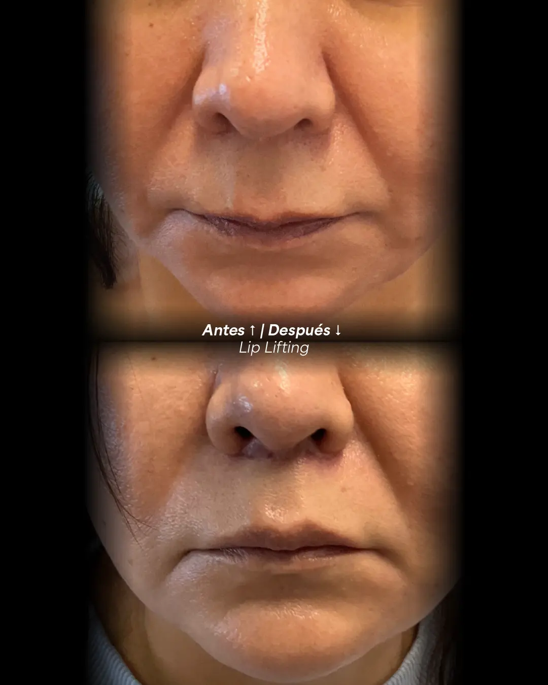 Upper lip before and after a lip lift