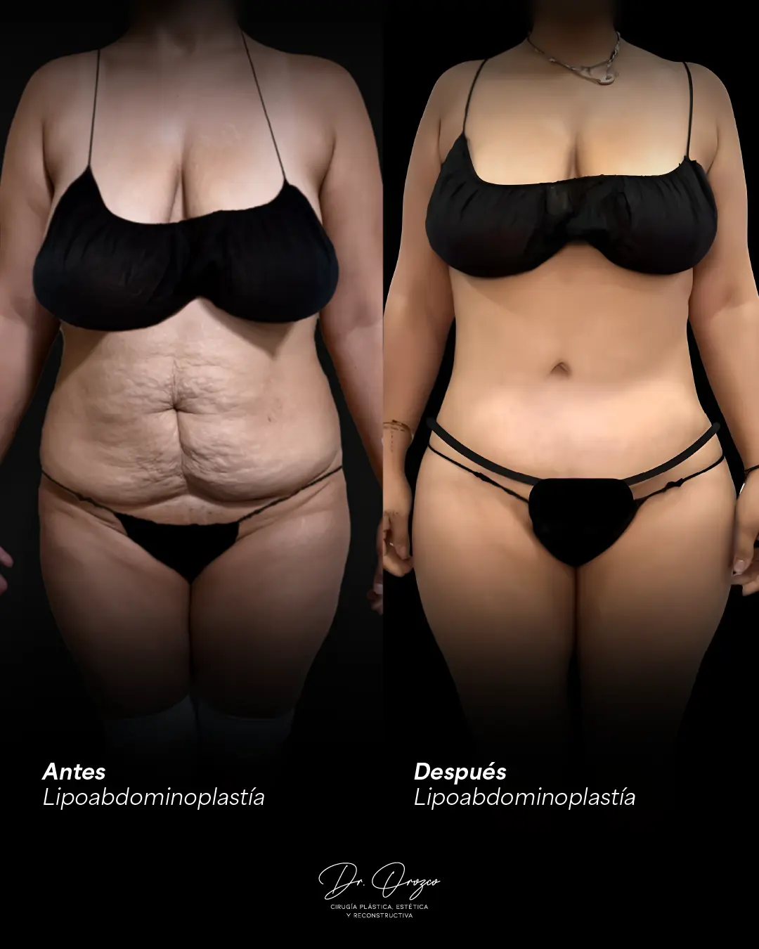 Abdomen avant et six mois après une abdominoplastie avec réparation musculaire