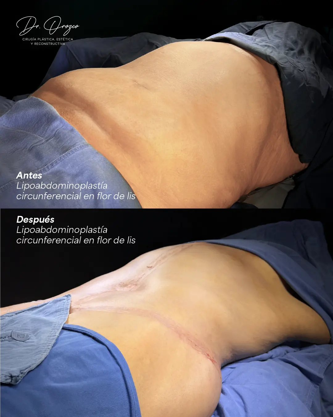 Profil abdominal avant et après une lipo-abdominoplastie