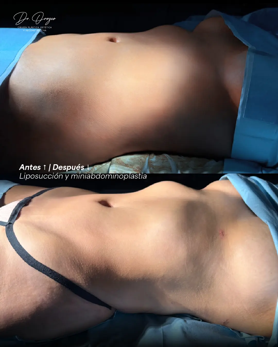 Abdomen and waist before and six months after 360° liposuction in Merida