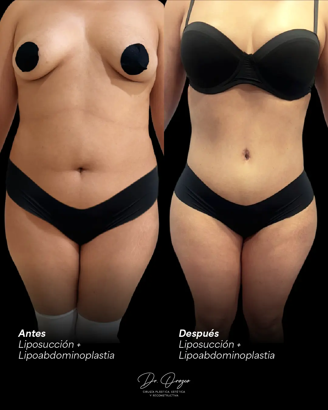 Abdomen et taille avant et après une liposuccion avec lipoabdominoplastie