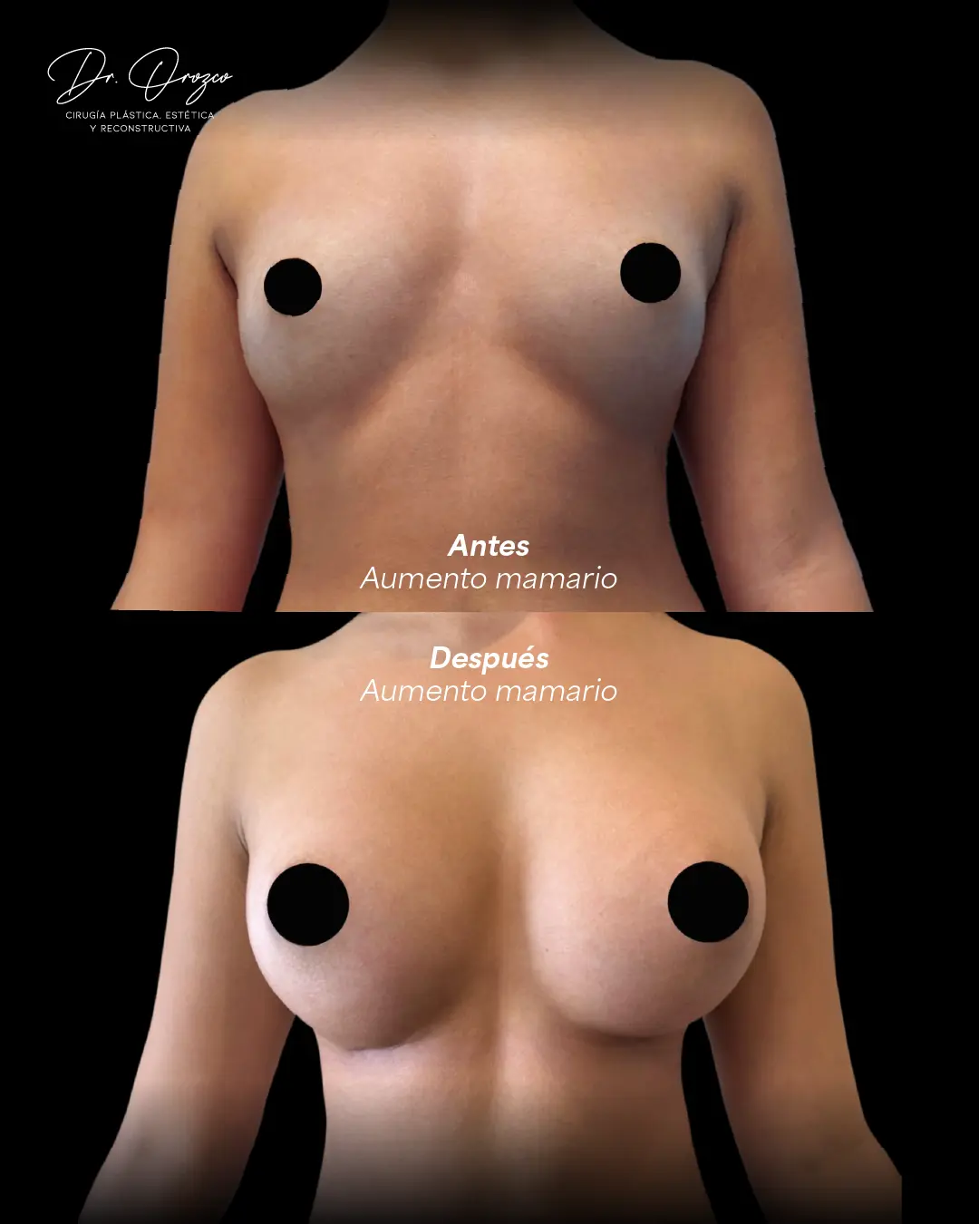 Breast augmentation result three months after surgery