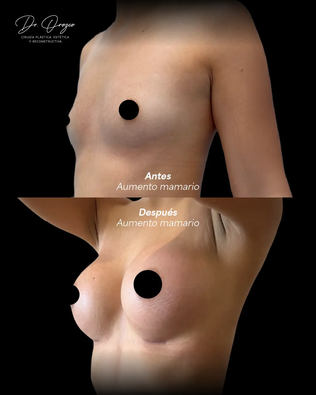 Breast profile before and after an implant augmentation