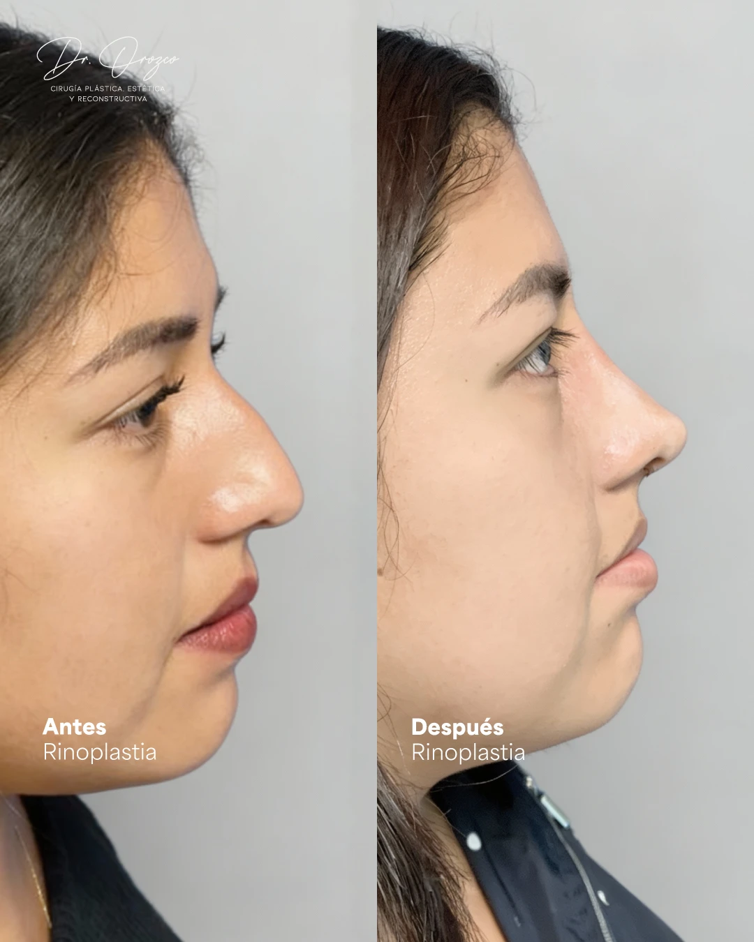 Nasal profile before and after rhinoplasty