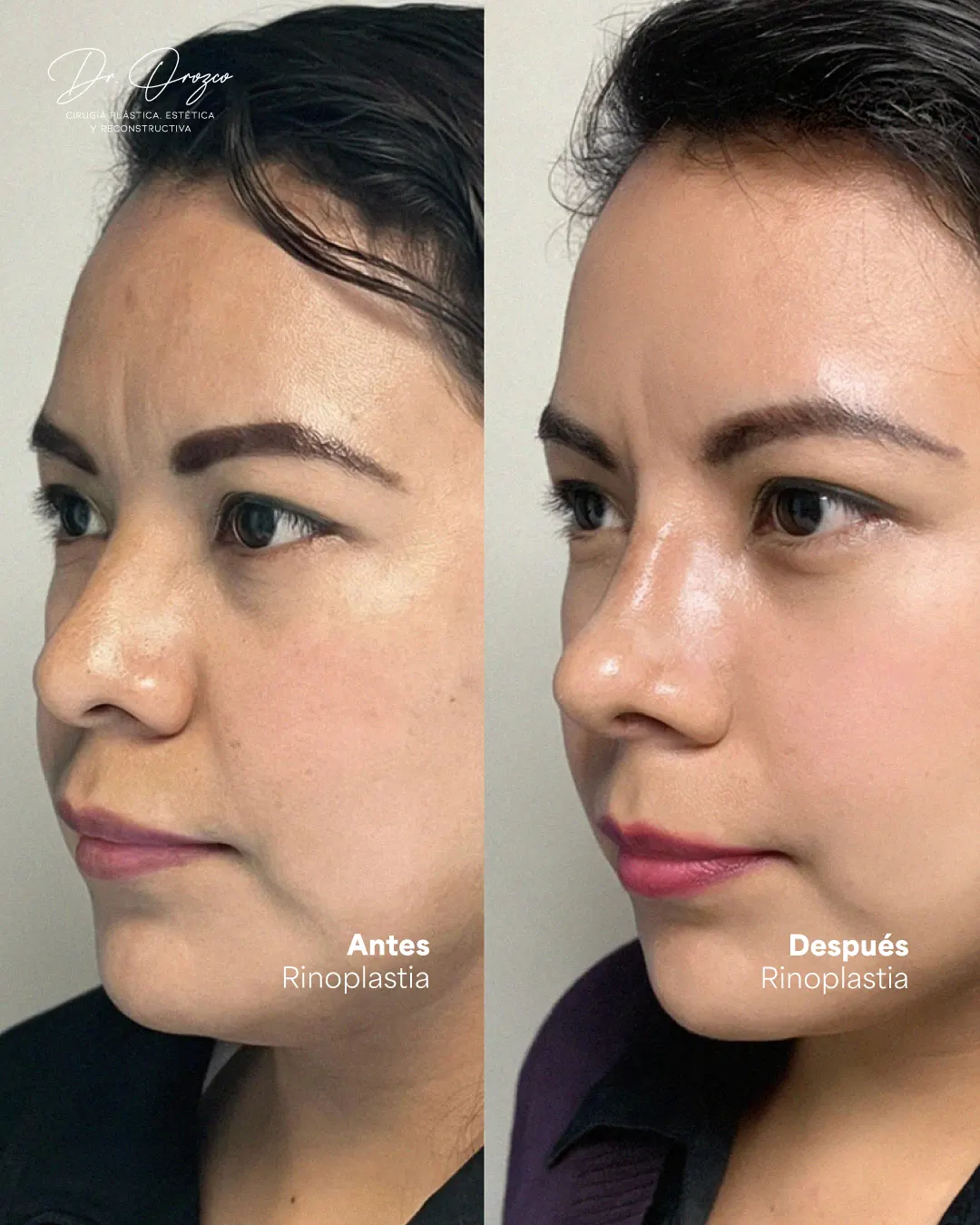 Nose before and after rhinoplasty, three-quarter view
