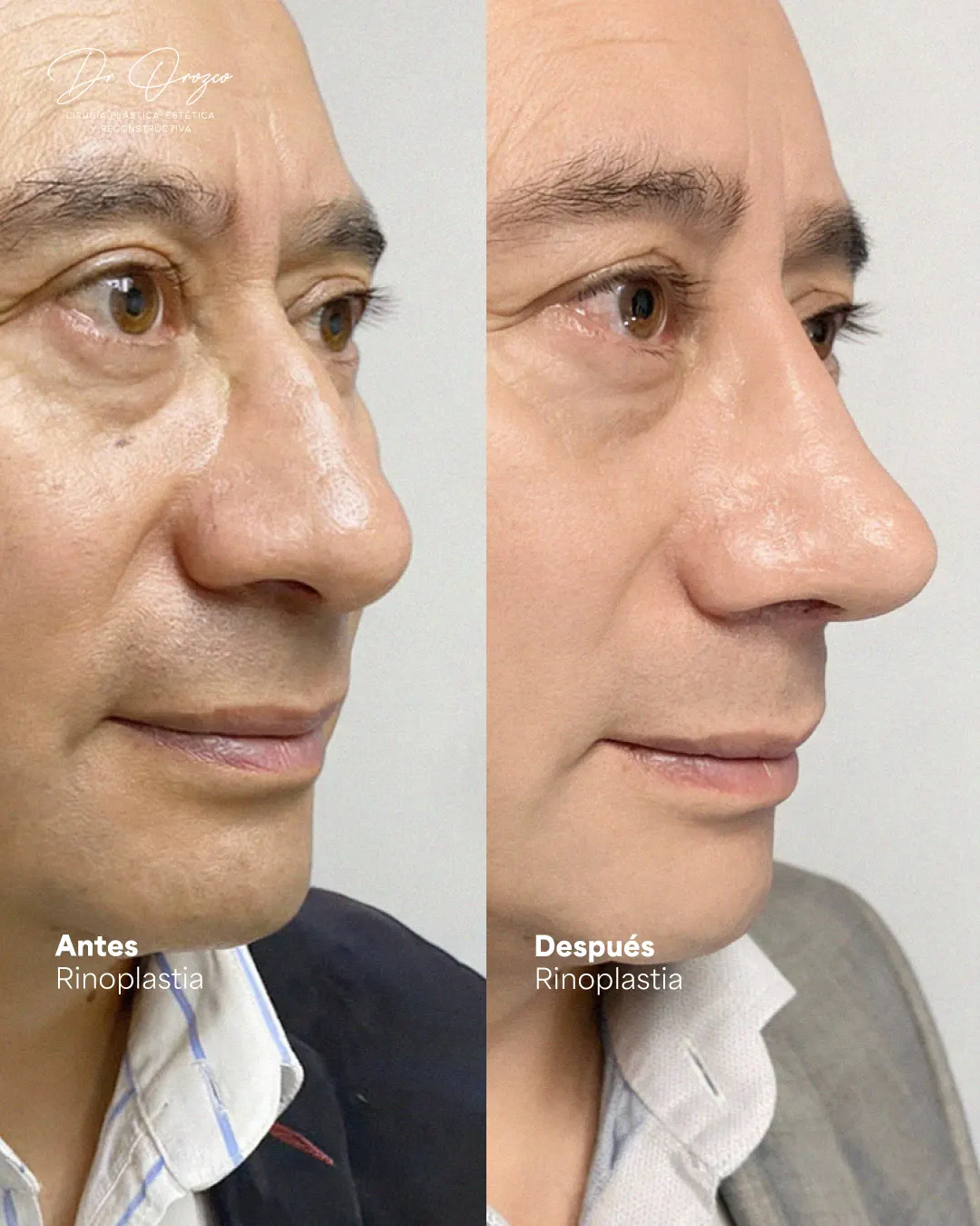 Nasal dorsum and tip before and after rhinoplasty in a male patient