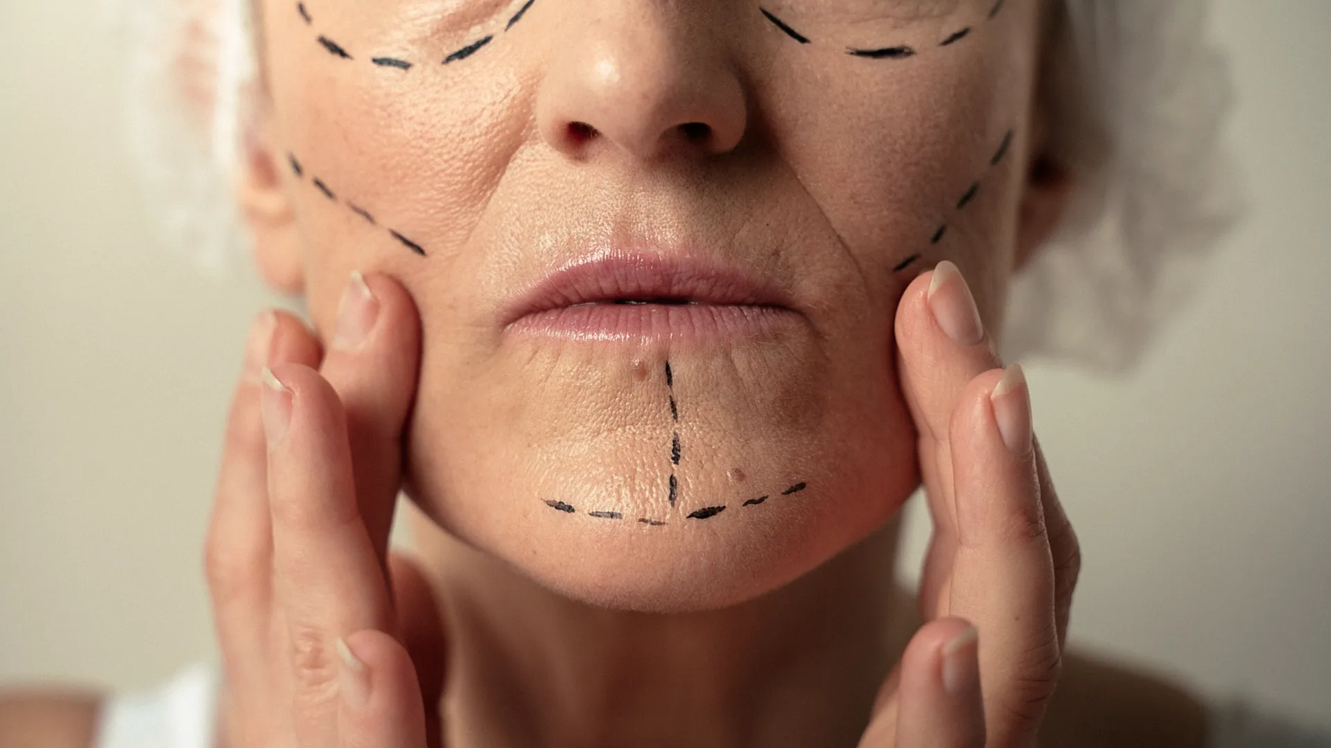 Facial aesthetic surgery in Merida with Dr. Orozco