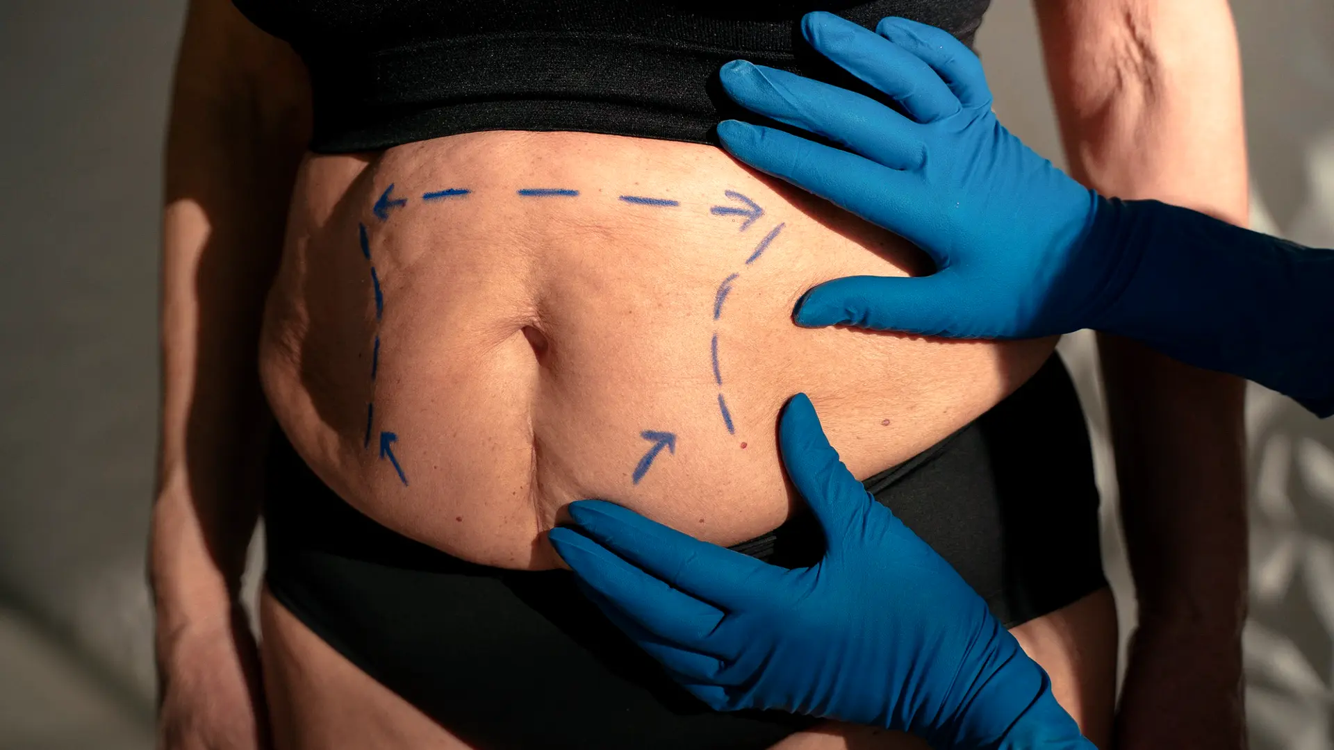 Abdominoplasty with muscle repair in Merida