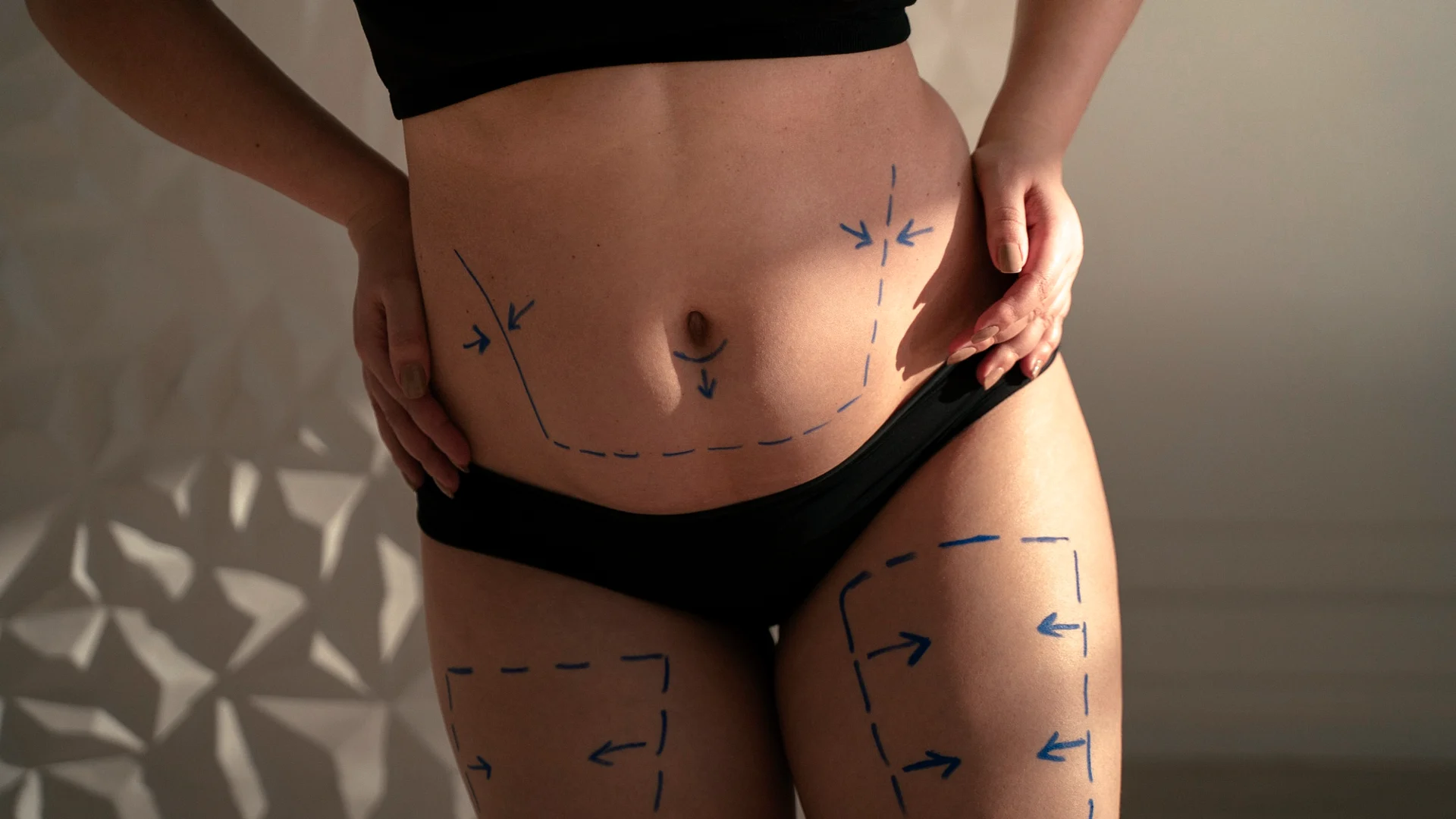 High-definition 360 liposuction performed in Merida