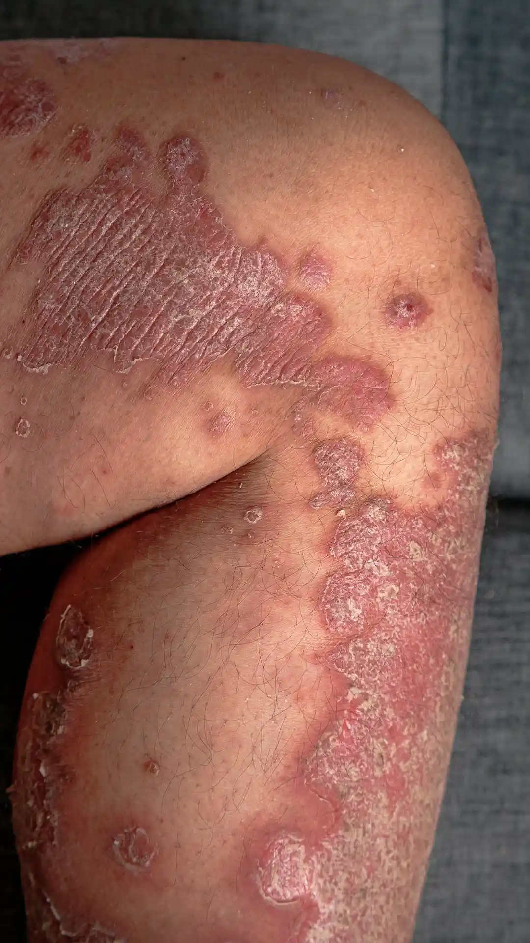 Burn care and reconstruction in Merida