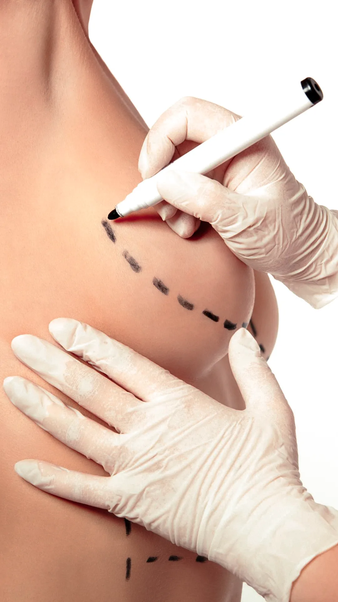 Breast reconstruction after mastectomy in Merida